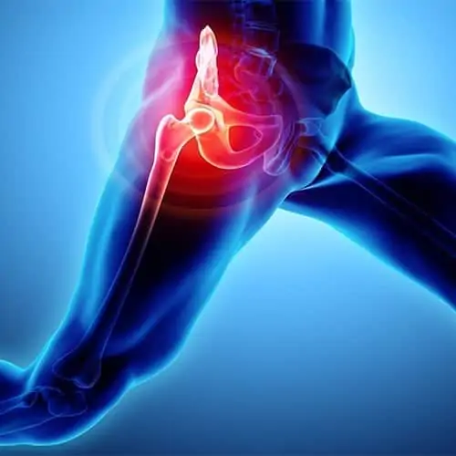 prothese de hanche douleur hanche luxee operation hanche chirurgie orthopedique du genou pied cheville hanche paris docteur olivier dejean clinique du sport paris